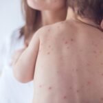 Sarampo de Volta: Novos casos no Brasil e baixa vacinação preocupam autoridades