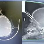 Menina de 1 ano fica com carregador cravado na testa após cair da cama em Divinópolis (MG)