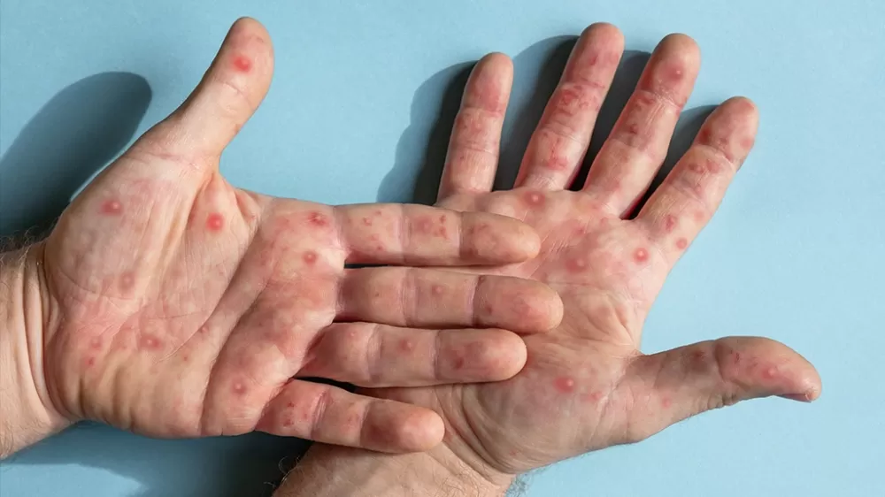 Cachoeiro de Itapemirim confirma caso de Mpox; alerta chega ao Noroeste Fluminense