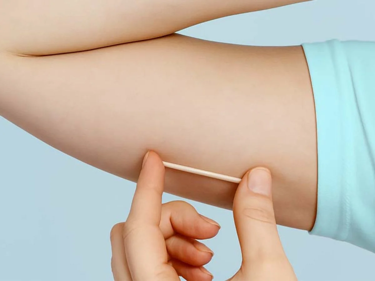 Prefeitura de Araruama (RJ) passa a oferecer implante contraceptivo gratuito na rede municipal de saúde