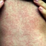 Espírito Santo registra 29 casos suspeitos de sarampo e alerta para baixa vacinação