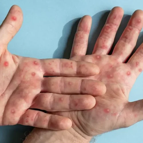 Cachoeiro de Itapemirim confirma caso de Mpox; alerta chega ao Noroeste Fluminense