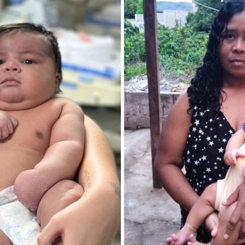 Sesa investiga parto normal que lesionou mãe e bebê de 6,5 kg no ES