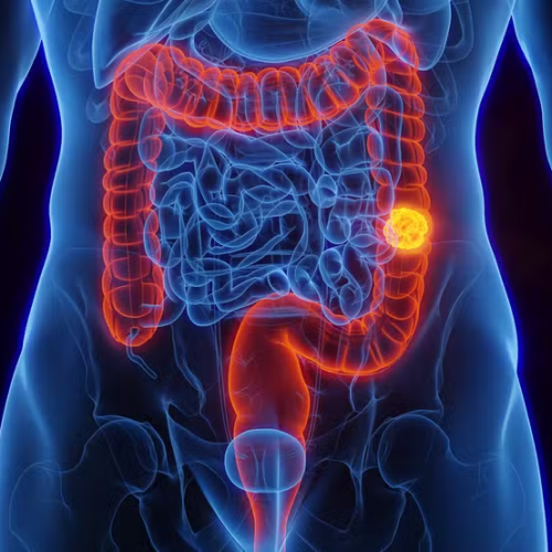 SUS adota novo exame para detectar câncer de intestino antes dos sintomas