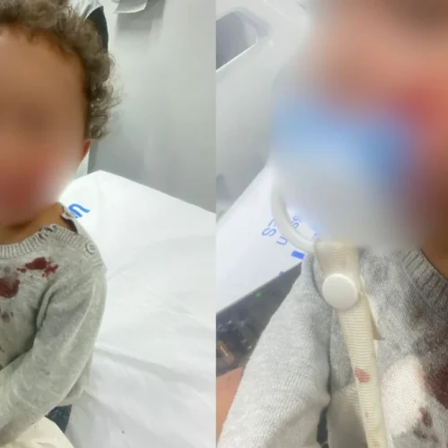 Bebê de um ano é atacado por pitbull em Marataízes (ES)