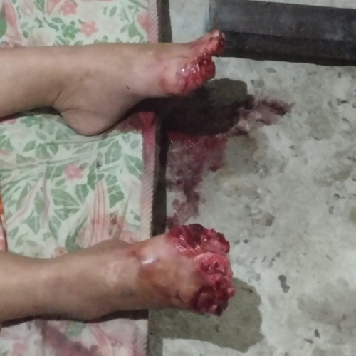 Mulher é encontrada com dedos dos pés amputados no bairro Guaritá em Itaperuna (RJ)