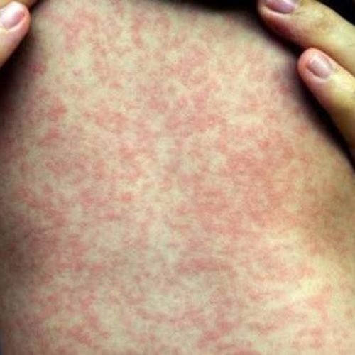 Espírito Santo registra 29 casos suspeitos de sarampo e alerta para baixa vacinação