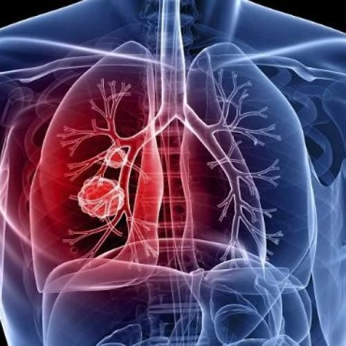Casos de tuberculose aumentam no Rio de Janeiro e acendem alerta em autoridades de saúde