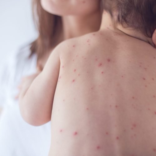 Sarampo de Volta: Novos casos no Brasil e baixa vacinação preocupam autoridades